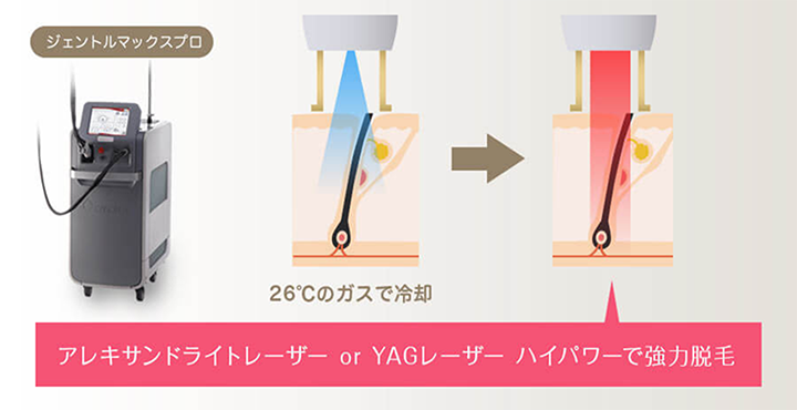 レーザー脱毛について